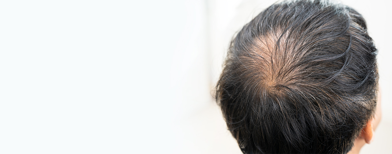 Alopecia Treatment