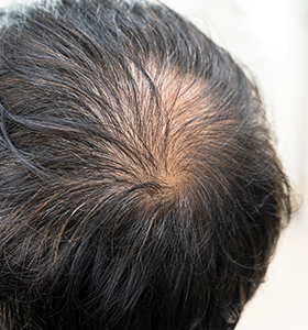 Alopecia Treatment