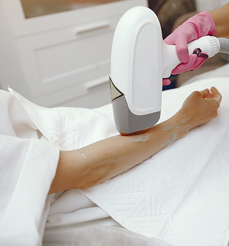 Laser Hair Removal