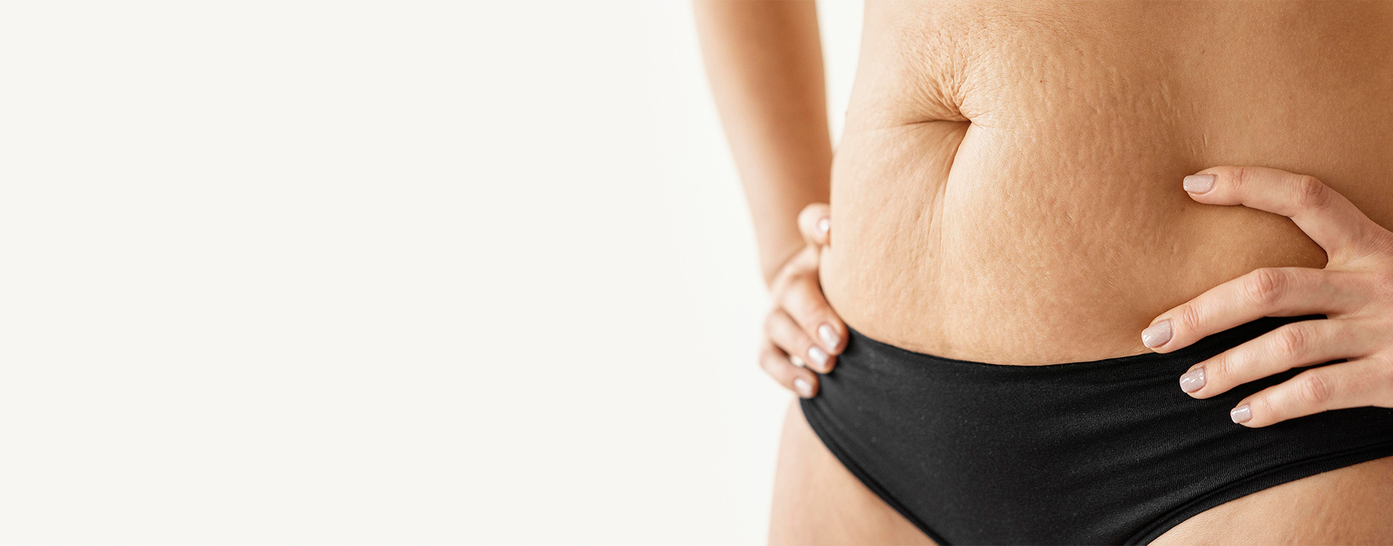 Stretch Marks Removal