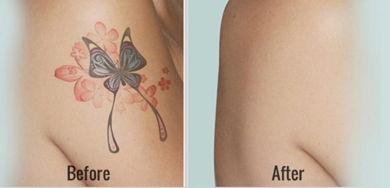Saline Tattoo Removal - One of the Best PMU Removal Methods – Toronto Brow  Shop